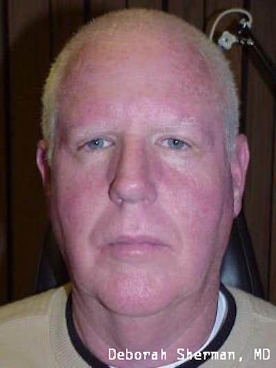 Direct Brow Lift Before & After Gallery - Patient 369150 - Image 2