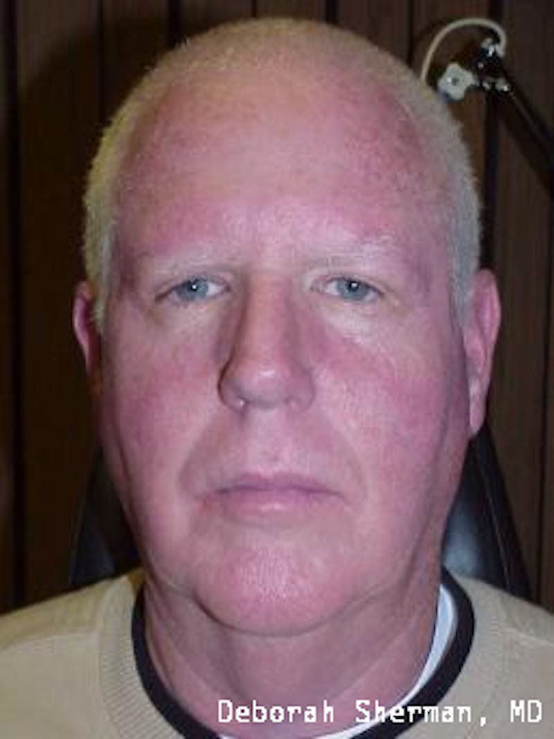 Direct Brow Lift Before & After Gallery - Patient 369150 - Image 2