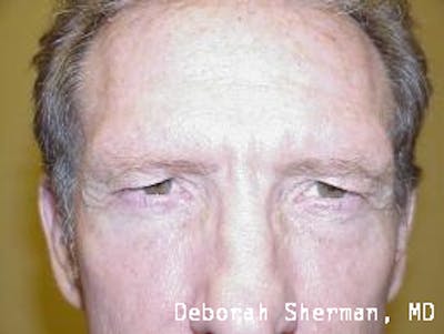Direct Brow Lift Before & After Gallery - Patient 342247 - Image 1