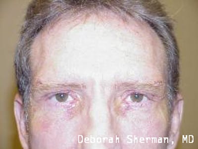 Direct Brow Lift Before & After Gallery - Patient 342247 - Image 2