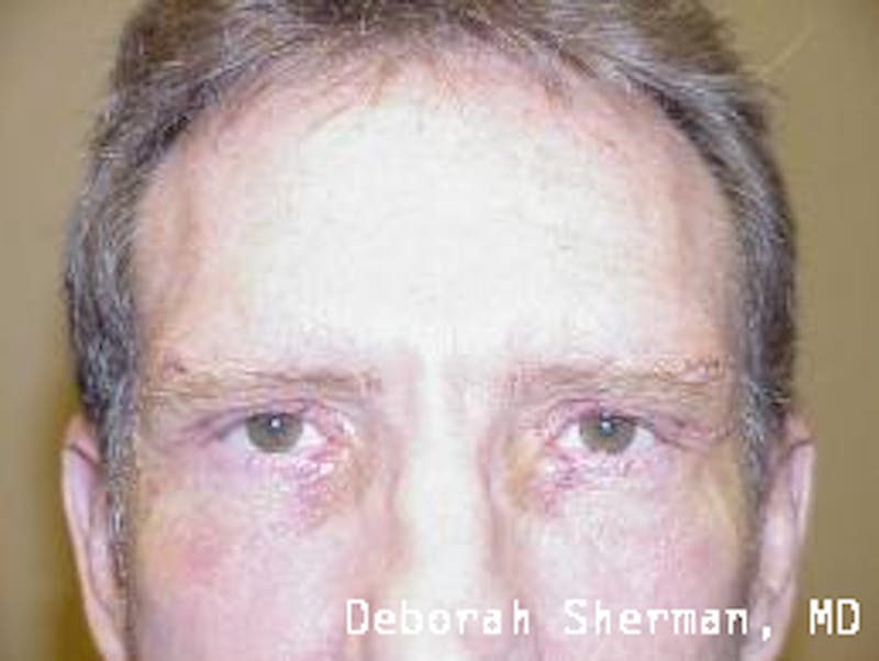Direct Brow Lift Before & After Gallery - Patient 342247 - Image 2