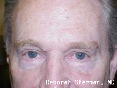 Direct Brow Lift Before & After Gallery - Patient 297674 - Image 2