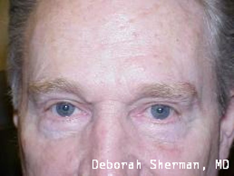 Direct Brow Lift Before & After Gallery - Patient 297674 - Image 2