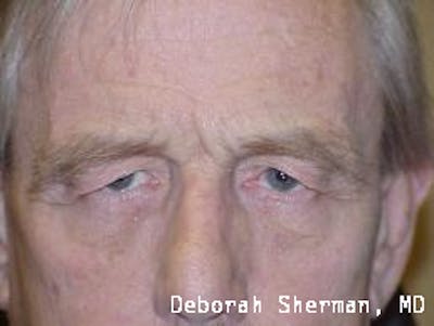Direct Brow Lift Before & After Gallery - Patient 272996 - Image 1