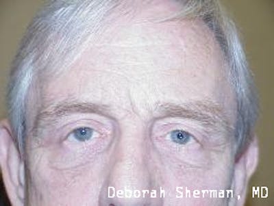 Direct Brow Lift Before & After Gallery - Patient 272996 - Image 2