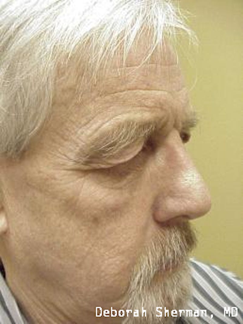 Direct Brow Lift Before & After Gallery - Patient 272996 - Image 3