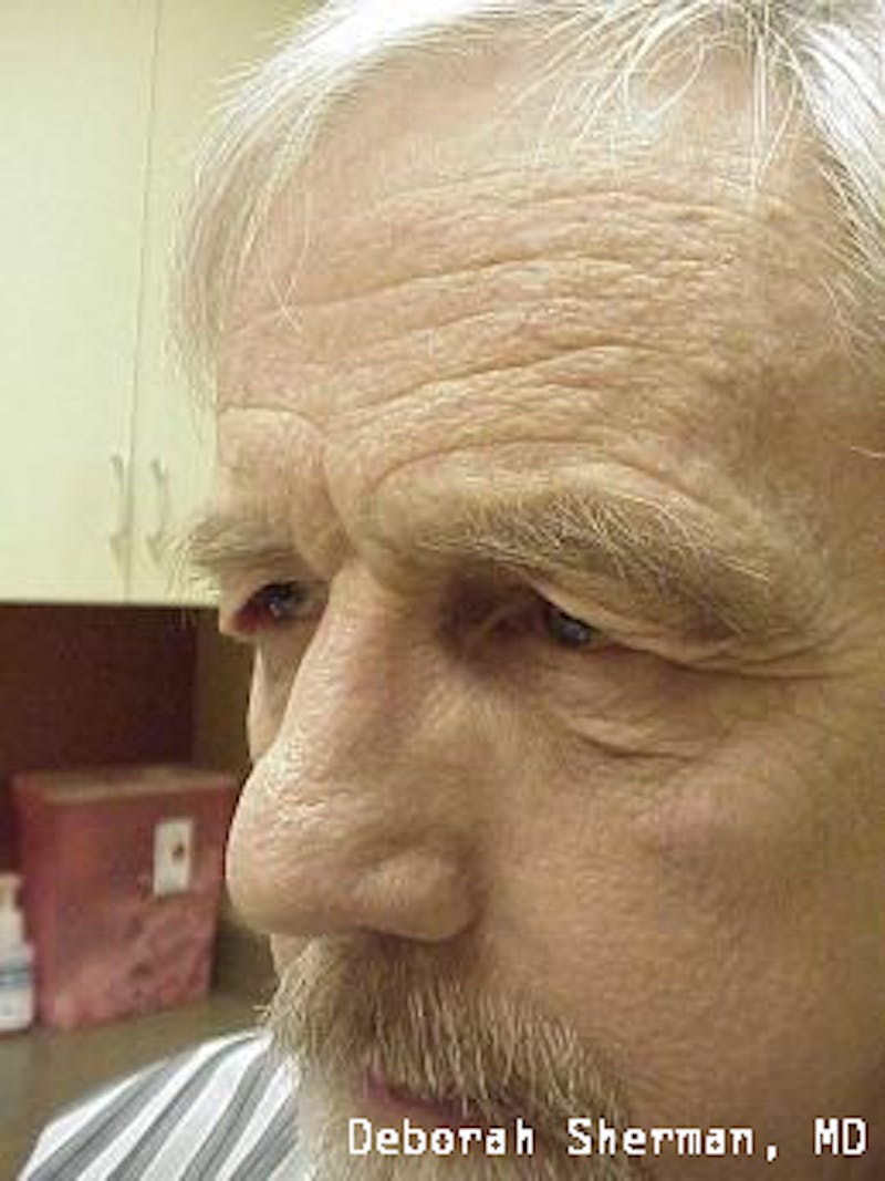 Direct Brow Lift Before & After Gallery - Patient 272996 - Image 5