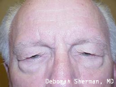 Direct Brow Lift Before & After Gallery - Patient 185278 - Image 1