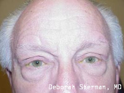 Direct Brow Lift Before & After Gallery - Patient 185278 - Image 2