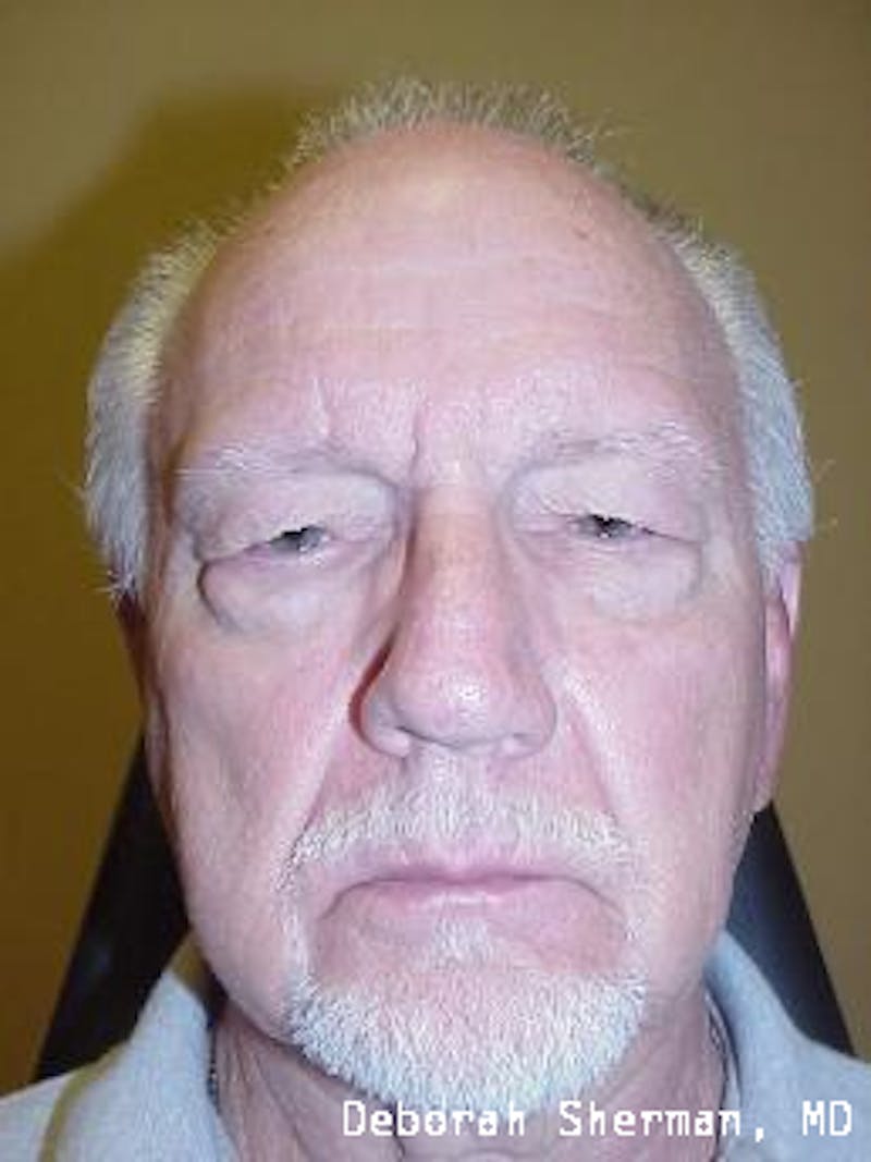 Direct Brow Lift Before & After Gallery - Patient 185278 - Image 3