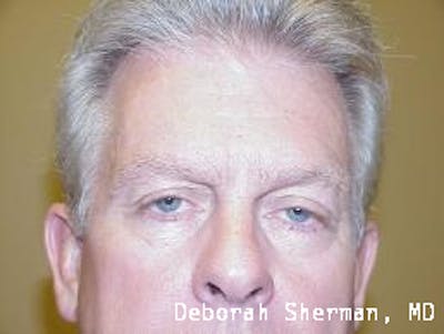 Eyelid Ptosis Repair Before & After Gallery - Patient 646180 - Image 1