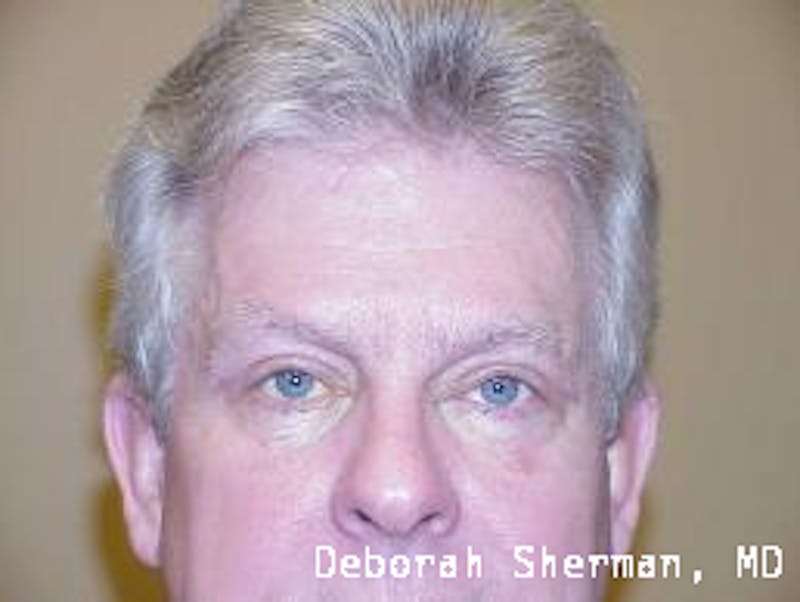 Eyelid Ptosis Repair Before & After Gallery - Patient 646180 - Image 2