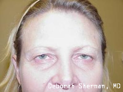 Eyelid Ptosis Repair Before & After Gallery - Patient 156515 - Image 1