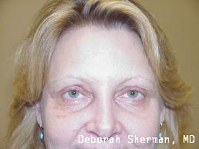 Eyelid Ptosis Repair Before & After Gallery - Patient 156515 - Image 2