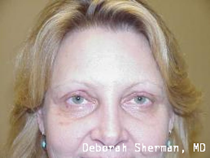 Eyelid Ptosis Repair Before & After Gallery - Patient 156515 - Image 2