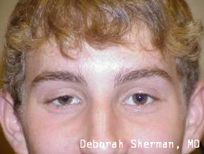 Eyelid Ptosis Repair Before & After Gallery - Patient 310258 - Image 1