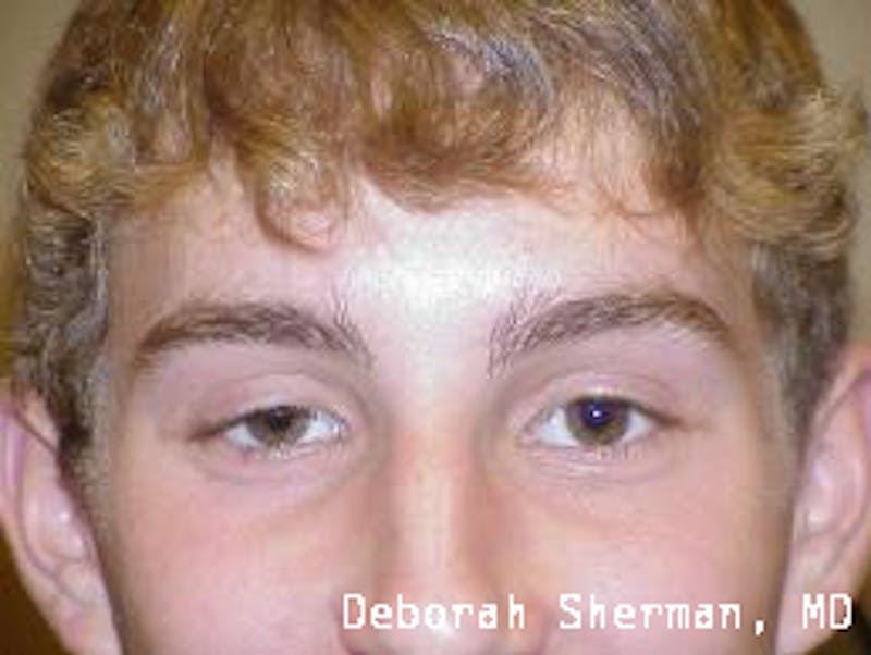 Eyelid Ptosis Repair Before & After Gallery - Patient 310258 - Image 1