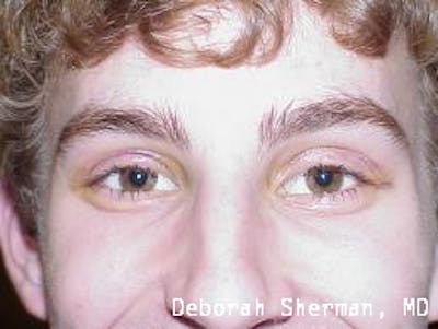 Eyelid Ptosis Repair Before & After Gallery - Patient 310258 - Image 2