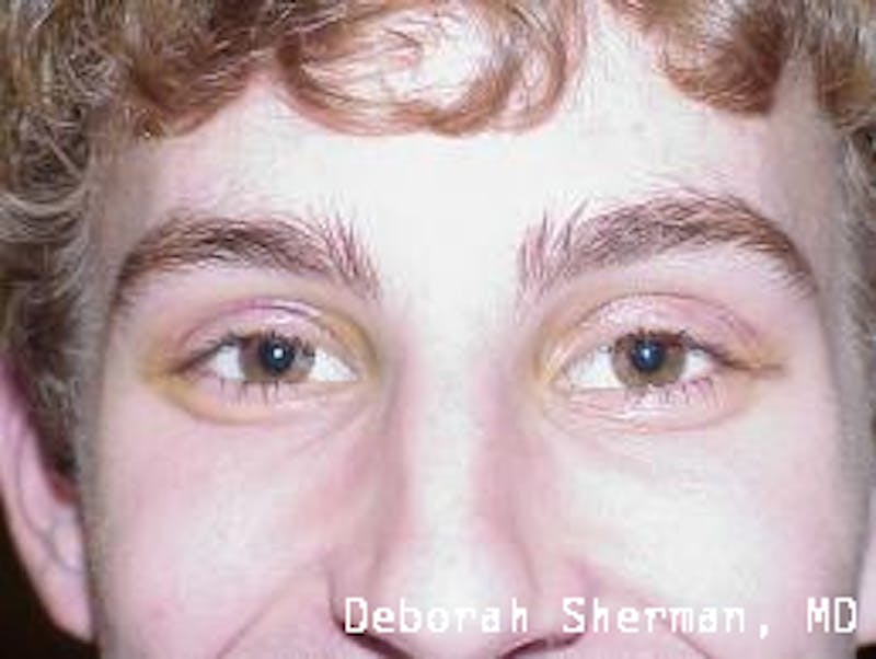 Eyelid Ptosis Repair Before & After Gallery - Patient 310258 - Image 2