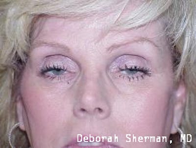 Eyelid Ptosis Repair Before & After Gallery - Patient 767980 - Image 1