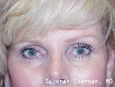 Eyelid Ptosis Repair Before & After Gallery - Patient 767980 - Image 2