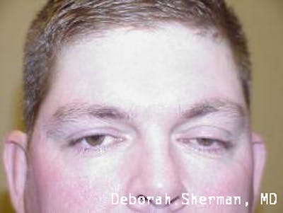 Eyelid Ptosis Repair Before & After Gallery - Patient 346886 - Image 1