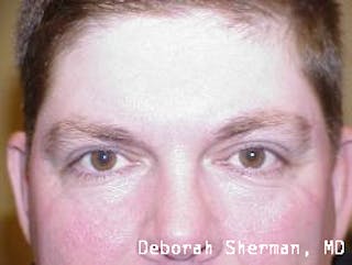 Eyelid Ptosis Repair Before & After Gallery - Patient 346886 - Image 2