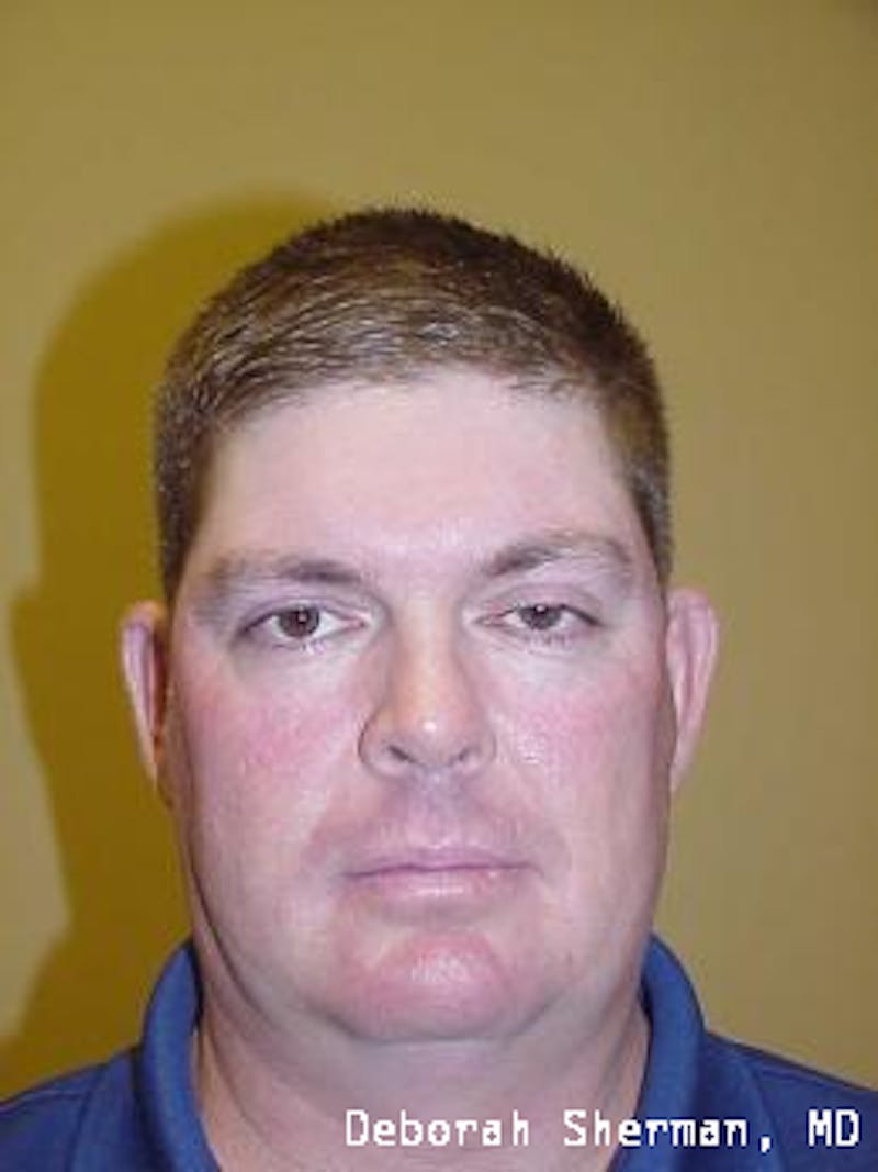 Eyelid Ptosis Repair Before & After Gallery - Patient 346886 - Image 3