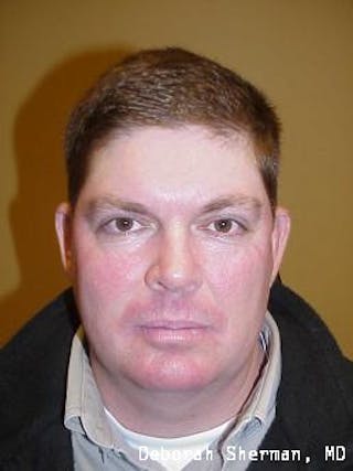 Eyelid Ptosis Repair Before & After Gallery - Patient 346886 - Image 4