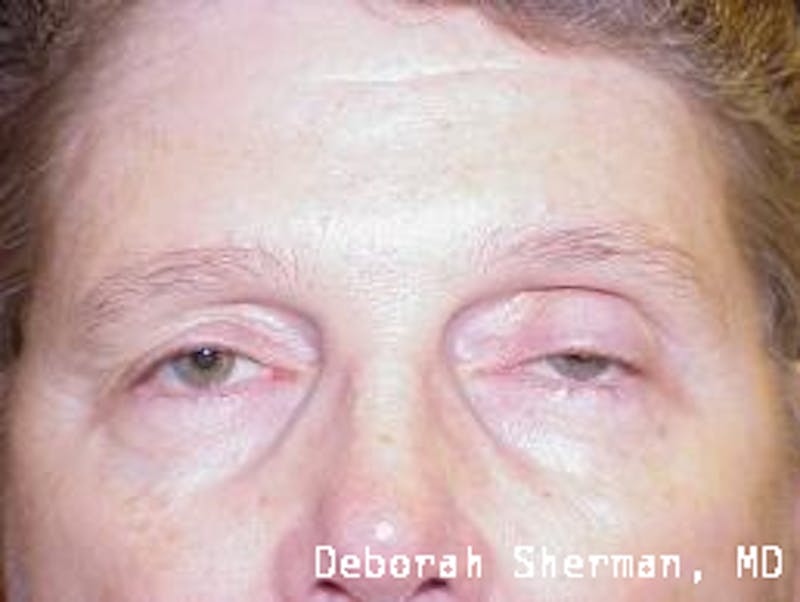 Eyelid Ptosis Repair Before & After Gallery - Patient 278658 - Image 1