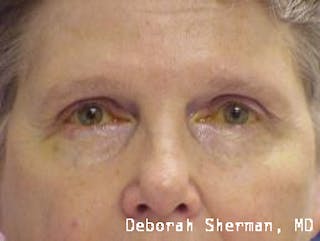 Eyelid Ptosis Repair Before & After Gallery - Patient 278658 - Image 2