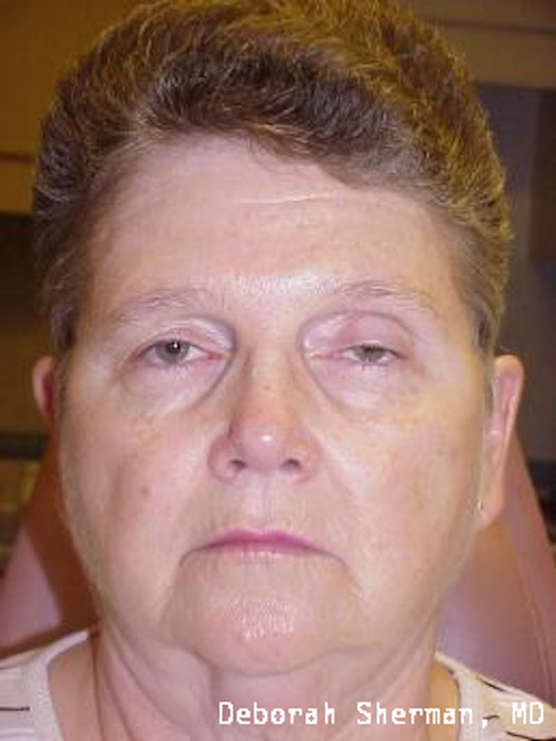 Eyelid Ptosis Repair Before & After Gallery - Patient 278658 - Image 3