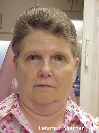 Eyelid Ptosis Repair Before & After Gallery - Patient 278658 - Image 4