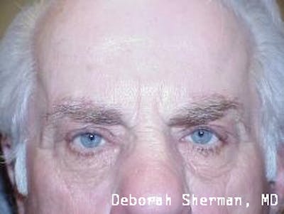 Eyelid Ptosis Repair Before & After Gallery - Patient 352284 - Image 2