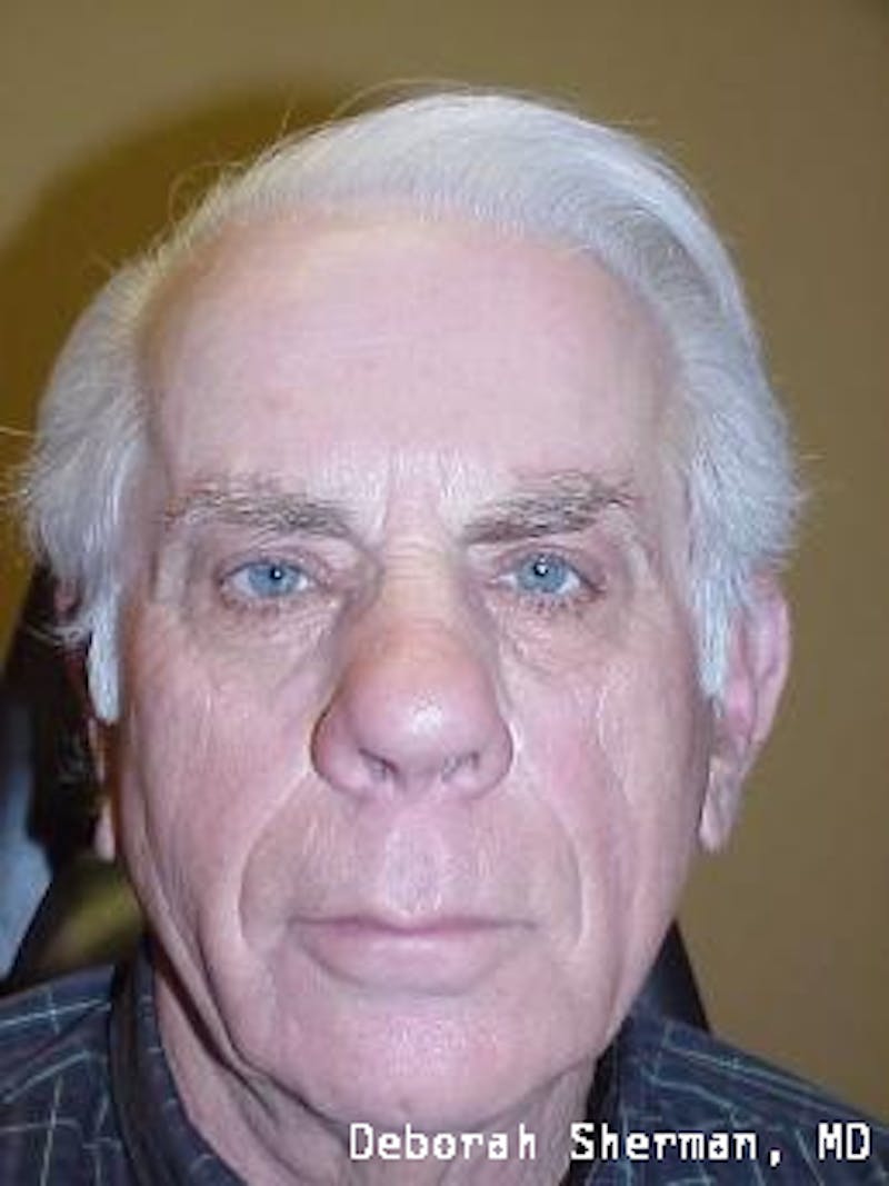 Eyelid Ptosis Repair Before & After Gallery - Patient 352284 - Image 4
