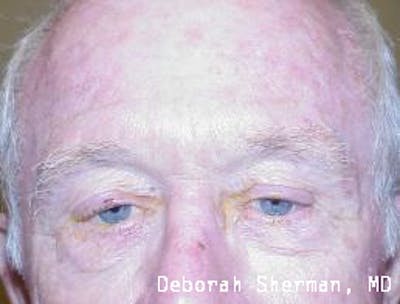 Eyelid Ptosis Repair Before & After Gallery - Patient 412960 - Image 1