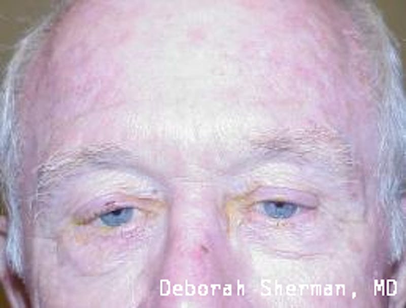 Eyelid Ptosis Repair Before & After Gallery - Patient 412960 - Image 1