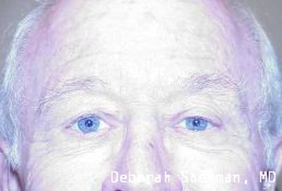 Eyelid Ptosis Repair Before & After Gallery - Patient 412960 - Image 2