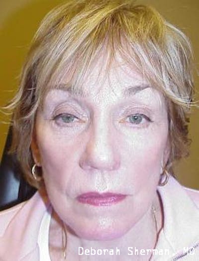 Eyelid Ptosis Repair Before & After Gallery - Patient 845291 - Image 1
