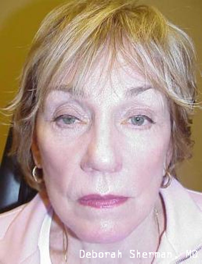 Eyelid Ptosis Repair Before & After Gallery - Patient 845291 - Image 1