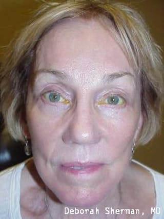 Eyelid Ptosis Repair Before & After Gallery - Patient 845291 - Image 2