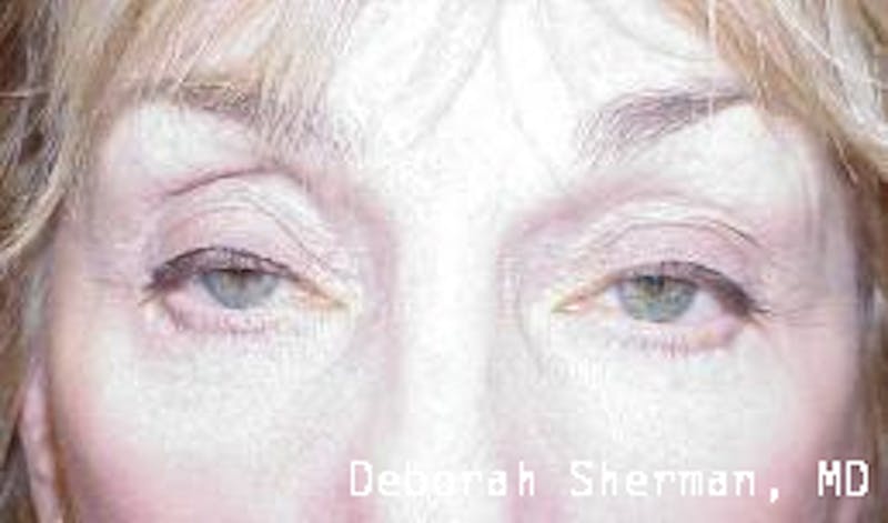 Eyelid Ptosis Repair Before & After Gallery - Patient 845291 - Image 3