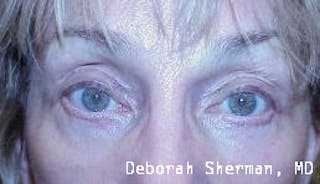 Eyelid Ptosis Repair Before & After Gallery - Patient 845291 - Image 4