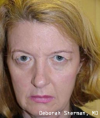 Endoscopic Brow Lift Before & After Gallery - Patient 327159 - Image 1