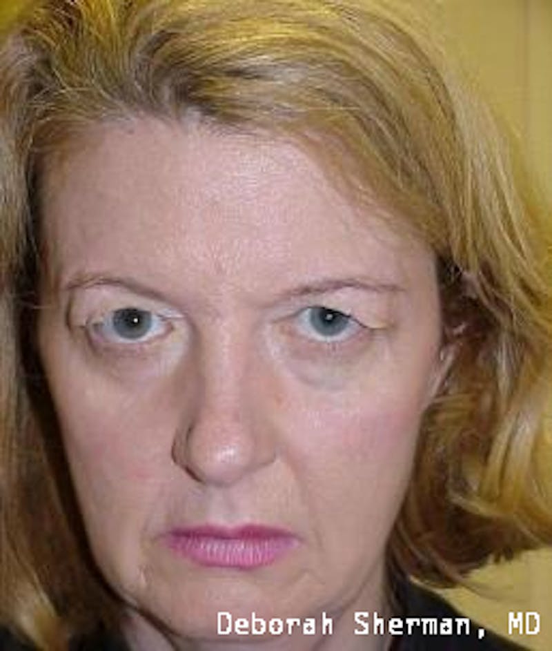 Endoscopic Brow Lift Before & After Gallery - Patient 327159 - Image 1
