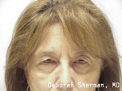 Endoscopic Brow Lift Before & After Gallery - Patient 704941 - Image 1