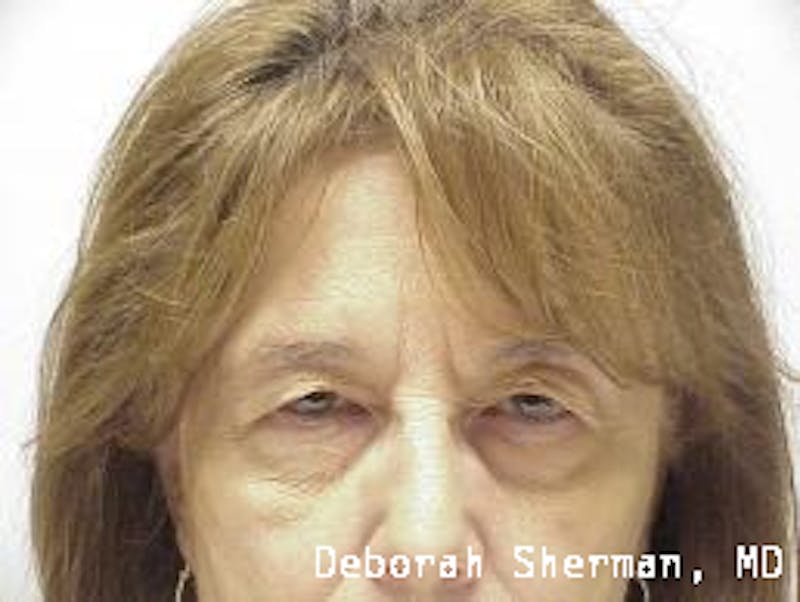 Endoscopic Brow Lift Before & After Gallery - Patient 704941 - Image 1