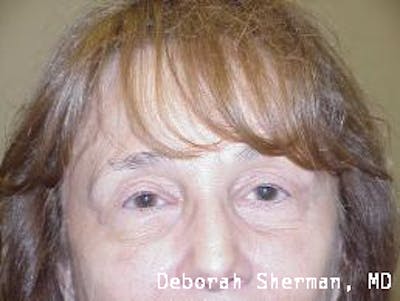 Endoscopic Brow Lift Before & After Gallery - Patient 704941 - Image 2