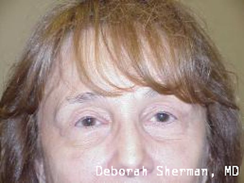 Endoscopic Brow Lift Before & After Gallery - Patient 704941 - Image 2