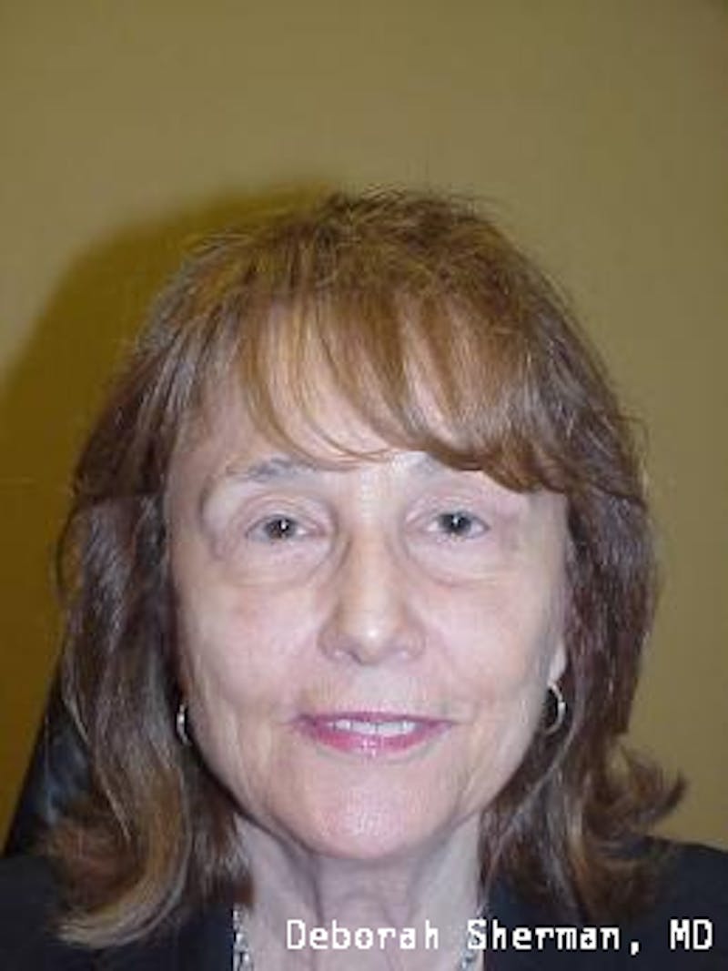 Endoscopic Brow Lift Before & After Gallery - Patient 704941 - Image 4